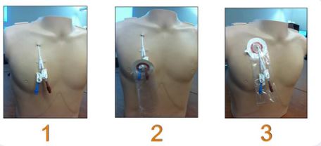 CATH DRY XL 12/Pack **One Pack per Month**